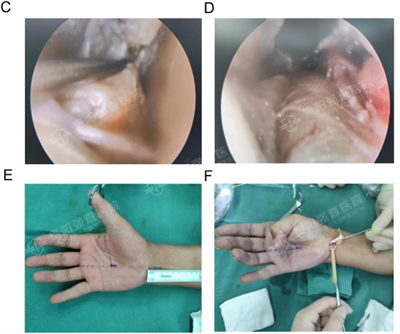 △圖2  C–D：腕橫韌帶增厚，鉤刀解剖腕橫韌帶，釋放正中神經(jīng)，可見散在尿酸鹽結(jié)晶。E–F：從屈指長肌腱刮除痛風(fēng)石之前和之后。