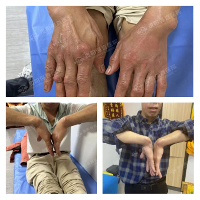  △腕管綜合征作為痛風(fēng)石的臨床癥狀很為罕見