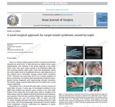 △圖：《Asian journal of surgy》刊登我院論文《A novel surgical approach for carpal tunnel syndrome caused by tophi》（一個治療痛風(fēng)石所致腕管綜合征的新手術(shù)方法）